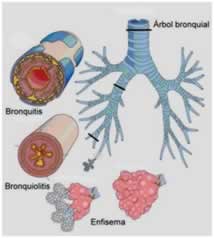 enfermedades respiratorias obstructivas