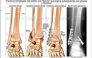 El tobillo anatomía y lesiones más frecuentesl