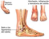 El tobillo anatomía y lesiones más frecuentesl