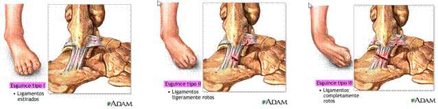 El tobillo anatomía y lesiones más frecuentesl