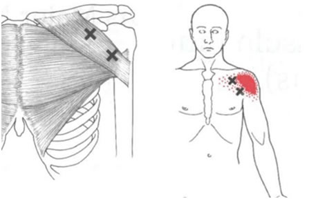 Caso clínico pilates