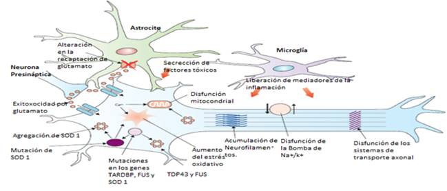 esclerosis lateral amiotrófica