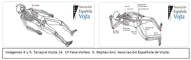 esclerosis lateral amiotrófica