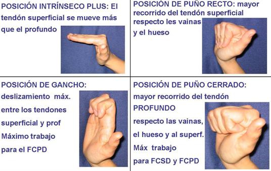 Lesiones de tendones flexores de mano