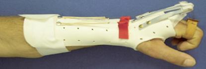 Lesiones de tendones flexores de mano
