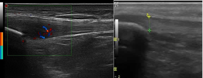 ecografia en fisioterapia