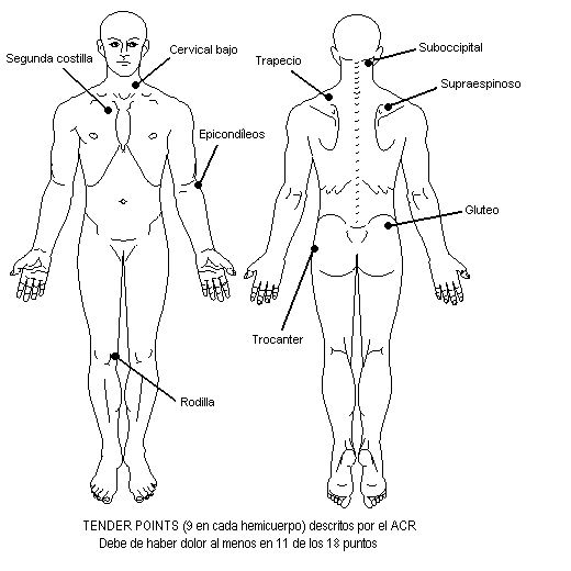 Fibromialgia Exploracion y diagnostico