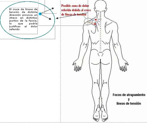 Análisis del dolor diseminado