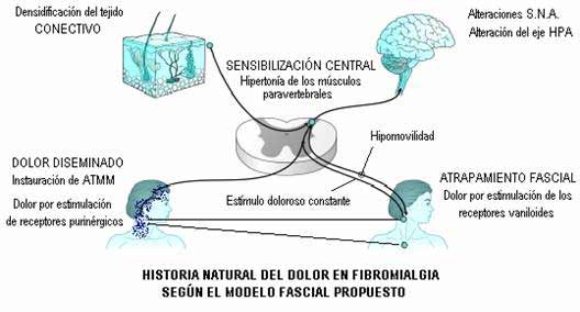 Historia natural del dolor fibromiálgico