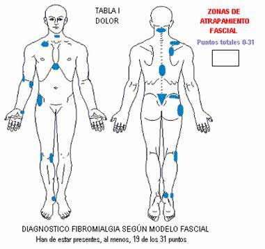 FIBROMIALGIA