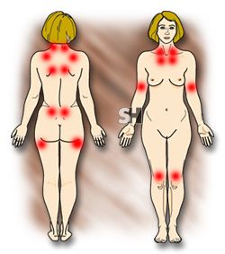 fibromialgia