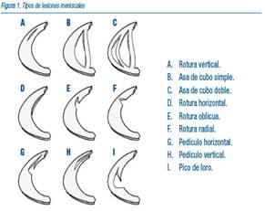 Lesiones Meniscales