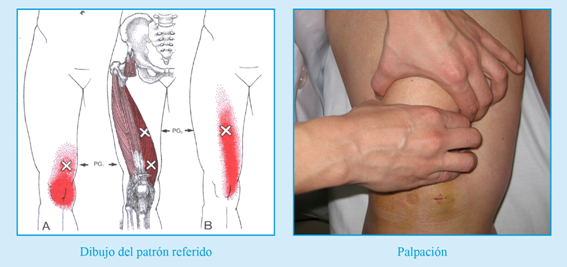 Puntos gatillo meniscectomia