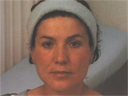 Flacidez y descolgamiento facial en diversas áreas de la cara (párpado superior, pómulo, cuello, men