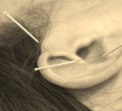 Auriculoterapia aplicada a la Fisioterapia Auriculoterapia aplicada a la Fisioterapia