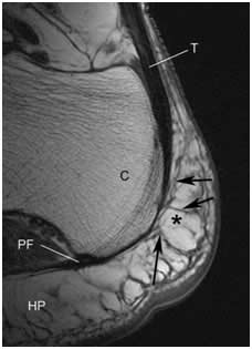 Comparación de la efectividad del tratamiento con movilización y técnicas de energia muscular de la articulación calcaneocuboidea, frente al tratamiento con ondas de choque extracorporeas, en la fascitis plantar