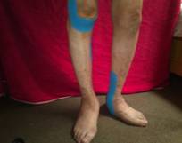 Mejora de la movilidad y correcion articular en artritis aplicando taping neuromuscular