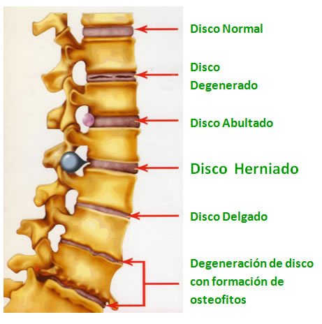 Ciática