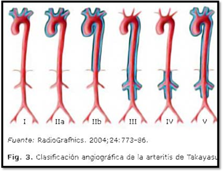 Arteritis de takayasu: reporte de caso clinico con intervencion de fisioterapia.