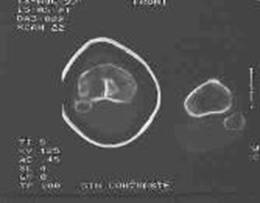 Fracturas de meseta tibial