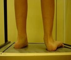 Rehabilitación y tratamiento ortesico en  pacientes con pie plano
