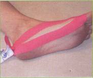 Hallux valgus tratamiento comparativo entre: kinesiotape, vendaje funcional y terapia manual