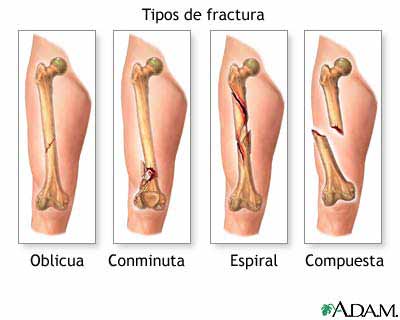 Generalidades de las fracturas