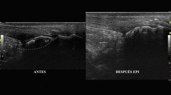 Tratamiento con la técnica EPI® de la Bursitis retrocalcanea