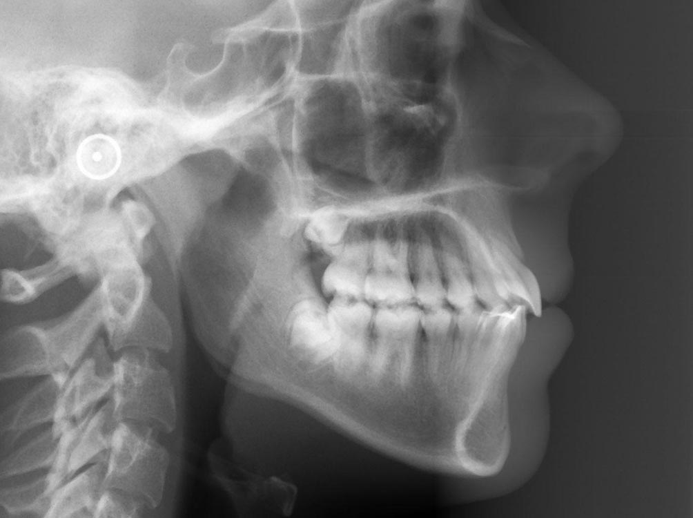 Protocolo de Fisioterapía para la Disfunción Temporomandibular