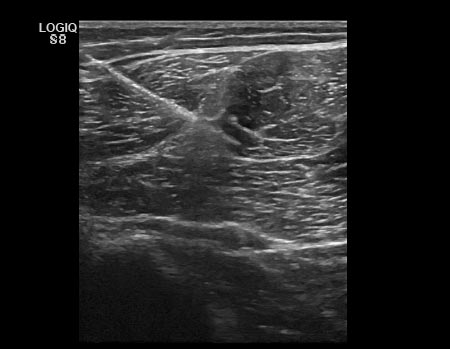 Técnica EPI® en el tratamiento de atrapamiento del nervio ciático por cicatriz fibrótica del Bíceps Femoral