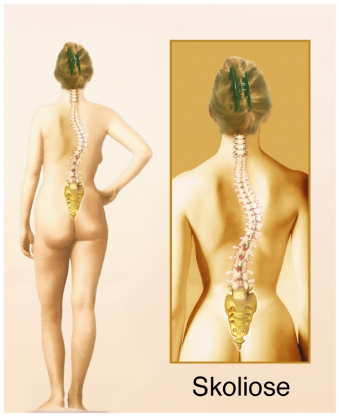 Escoliosis: ¿enfermedad de la columna o adaptación del cuerpo? Escoliosis: ¿enfermedad de la columna o adaptación del cuerpo?