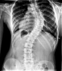 Revisión bibliográfica sobre la efectividad de la fisioterapia en pacientes con escoliosis Revisión bibliográfica sobre la efectividad de la fisioterapia en pacientes con escoliosis
