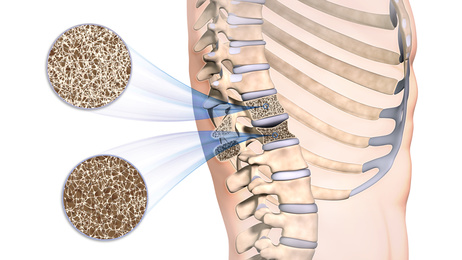 FISIOTERAPIA, UNA ALTERNATIVA EFICAZ PARA COMBATIR LA OSTEOPOROSIS.