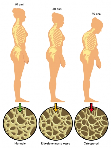 Recomendaciones para el paciente - osteoporosis