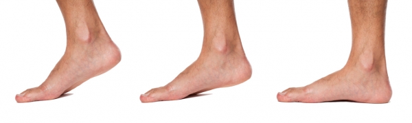 Tratamiento kinésico – físico de pie plano