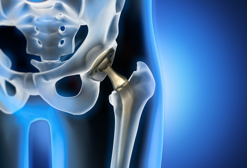 Abordajes de la hidroterapia en la rehabilitación de la prótesis de cadera