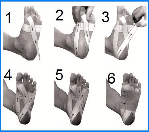 Fisioterapia para la fascitis plantar: ¿Ayuda?