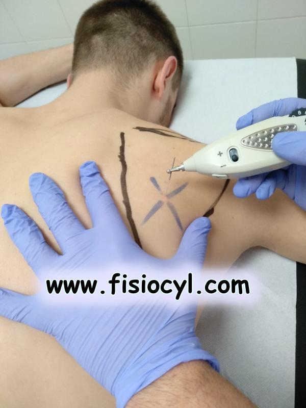 Curso de Neuromodulación y electropunción en el dolor crónico y agudo Curso de Neuromodulación y electropunción en el dolor crónico y agudo