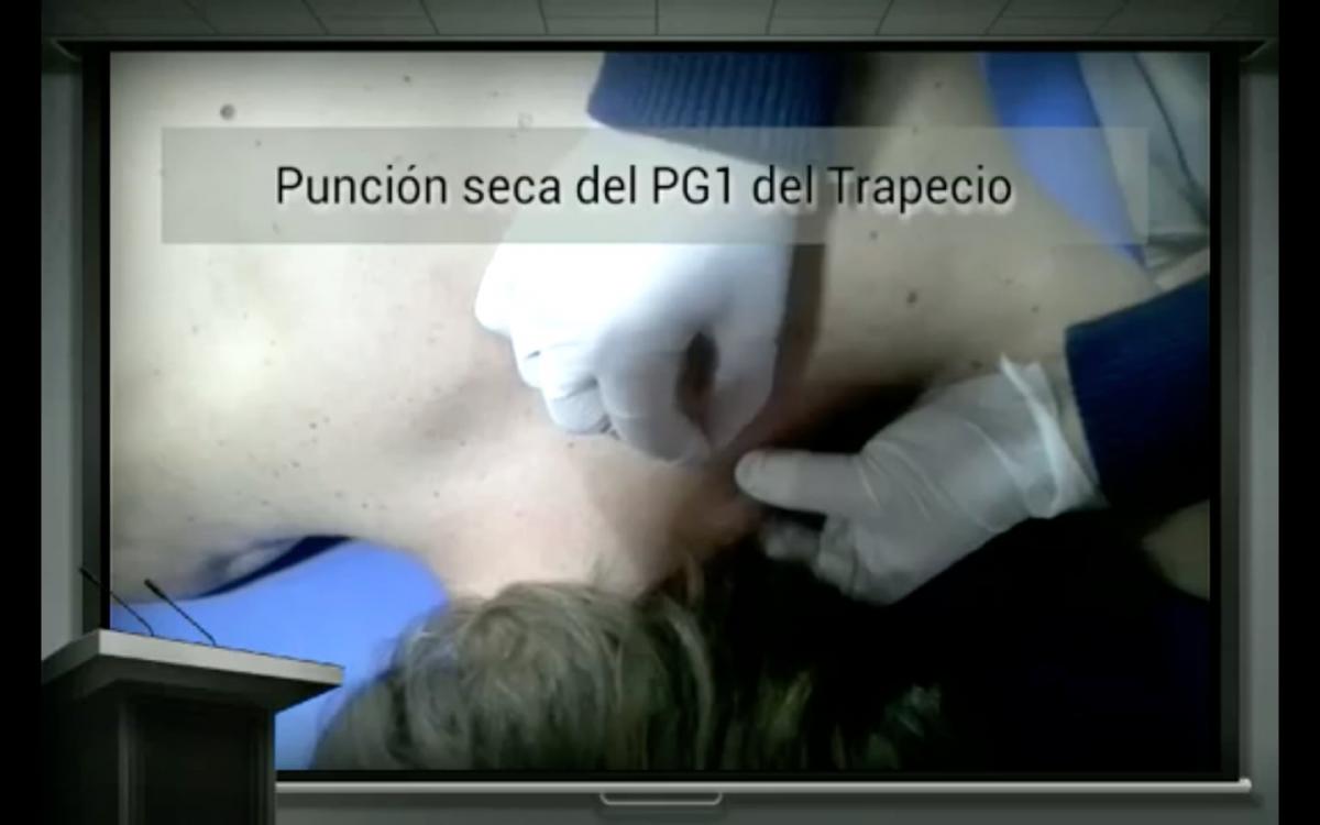 Fisioterapia invasiva: Puntos gatillo y punción seca en el dolor musculoesquelético Fisioterapia invasiva: Puntos gatillo y punción seca en el dolor musculoesquelético