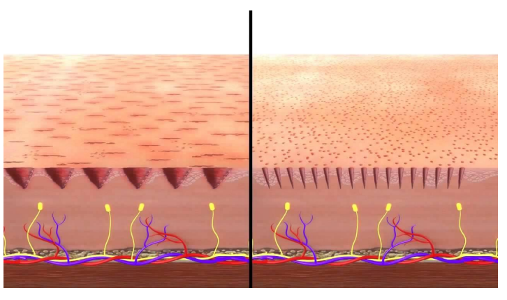Microneedling para fisioterapeutas Microneedling para fisioterapeutas