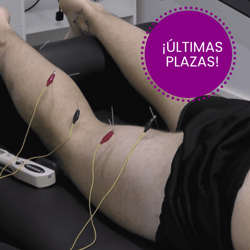 Neuromodulación percutanea: neuroelectroestimulación segmentaria