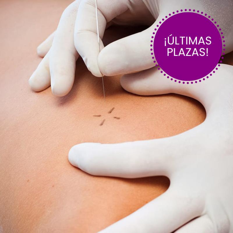 CURSO DE VERANO: Punción seca en el síndrome del dolor miofascial (puntos gatillo miofasciales) CURSO DE VERANO: Punción seca en el síndrome del dolor miofascial (puntos gatillo miofasciales)