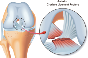 Rotura del ligamento cruzado anterior (LCA) -  Anterior cruciate ligament (ACL) tear “Protocolos de rehabilitación postquirúrgica en pacientes con rotura del ligamento cruzado anterior”
