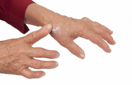Recomendaciones para el paciente - artritis reumatoide.