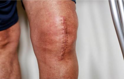 El movimiento inmediato como la mejor estrategia para conservar el músculo y la movilidad tras la cirugía de rodilla 
