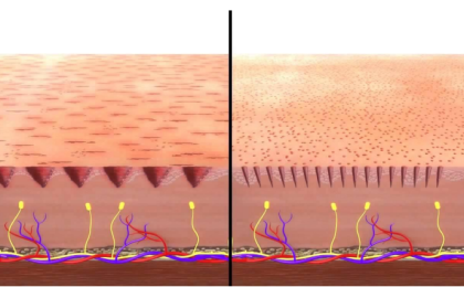 Microneedling para fisioterapeutas