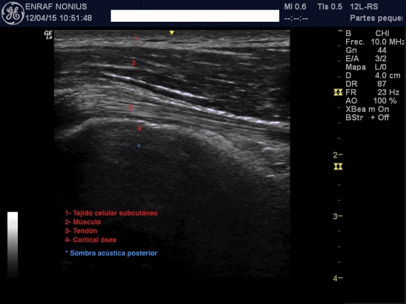 Ecografía en fisioterapia
