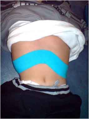 foto primera aplicacion abdominal (debajo costillas)