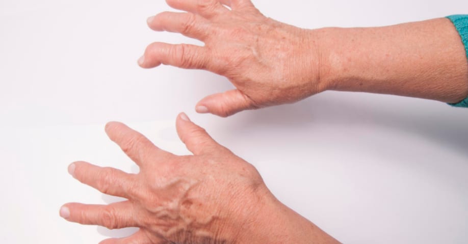 Artrosis de mano