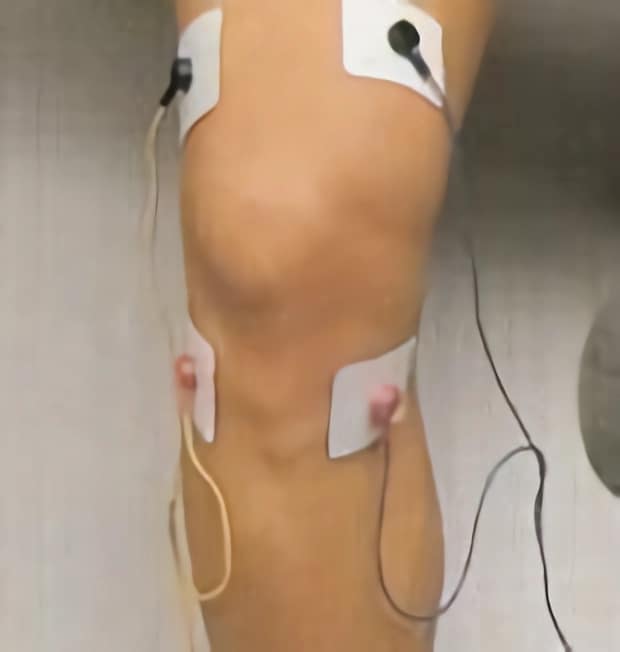 Colocación de electrodos para dolor local en la rodilla